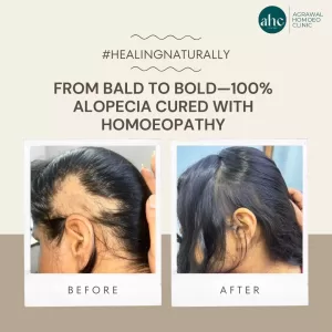 Alopecia is aserious issue more than cosmatic for all.