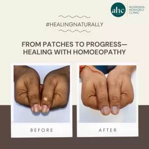 vitiligo challenge won at AHC
